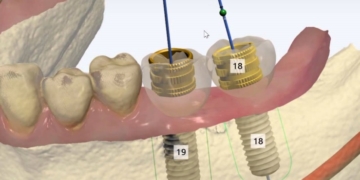 An Introduction to Guided Surgery – 12 Feb, 2018